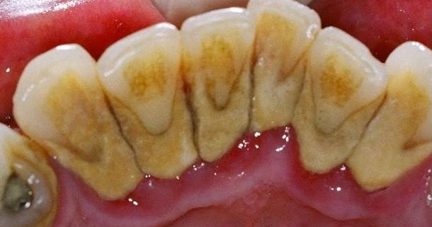 Diş Daşı yaranma sebebleri ve temizlenmesi Diş Hekimi Pərviz Suleymanov