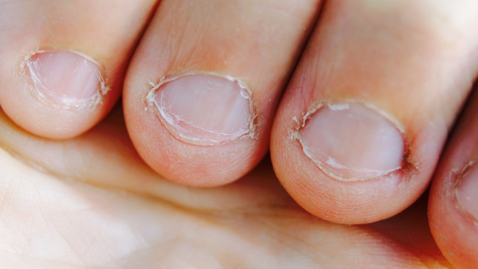 Mesmerizing Words Researchers Explain What Biting Your Nails Says