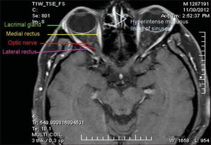 Orbit MRI Anatomy Radiology Anatomy Images orbit-mri-anatomy-radiology-anatomy-images