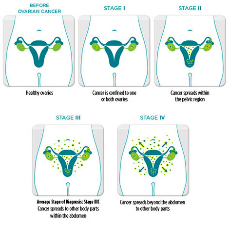 Ovarian cancer stages