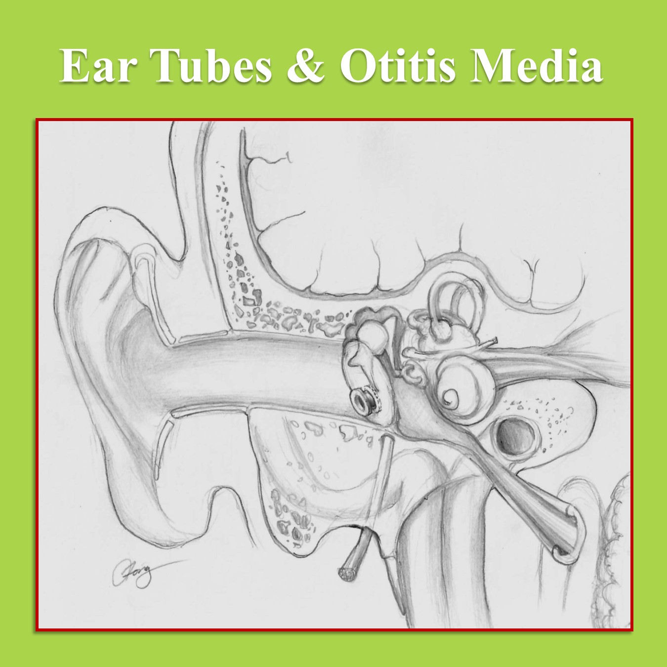 Ear tubes and otitis media