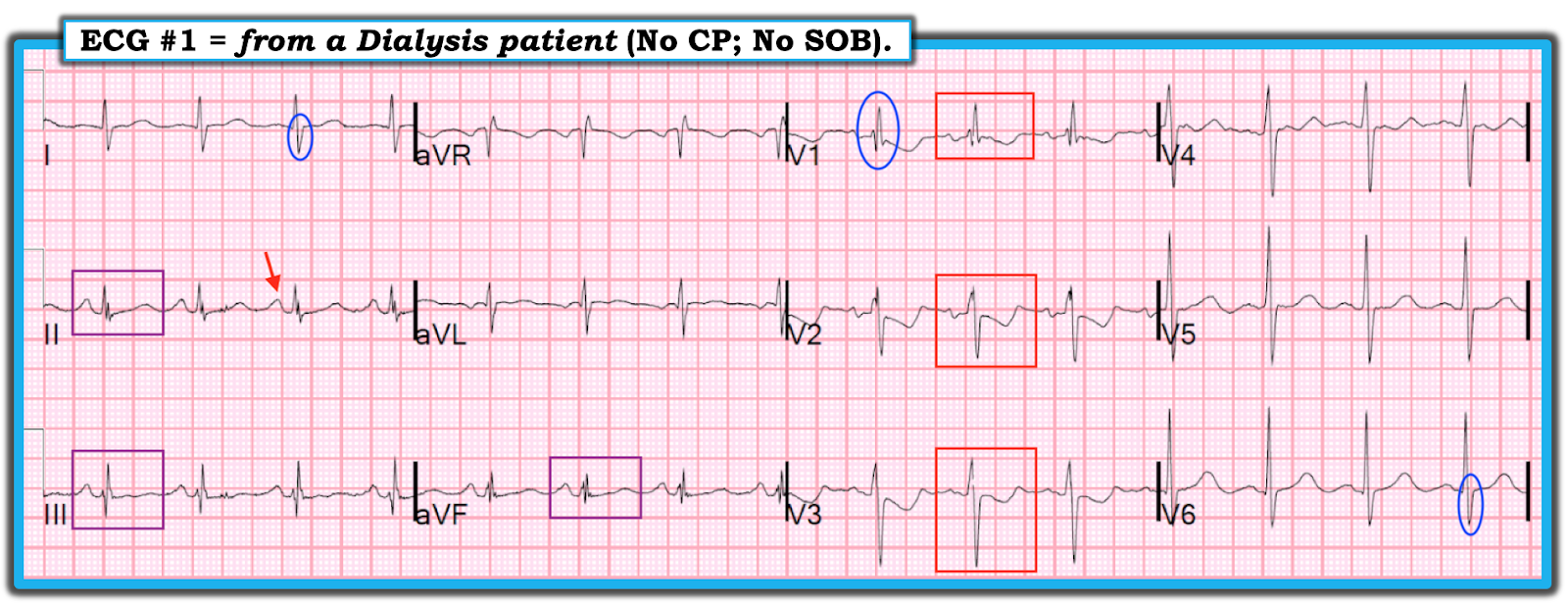 Ekg V2 V3 | ECG signs of myocardial infarction: pathological Q-waves ...