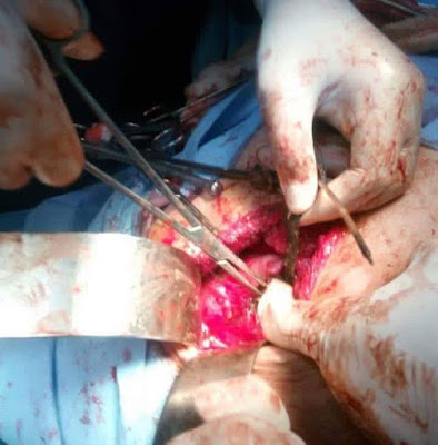  Doctors Remove Nails, Pens, Spoon From Stomach Of Woman With Medical Conditon Jolk1
