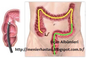 menier sendromu hemoroid basur mayasil