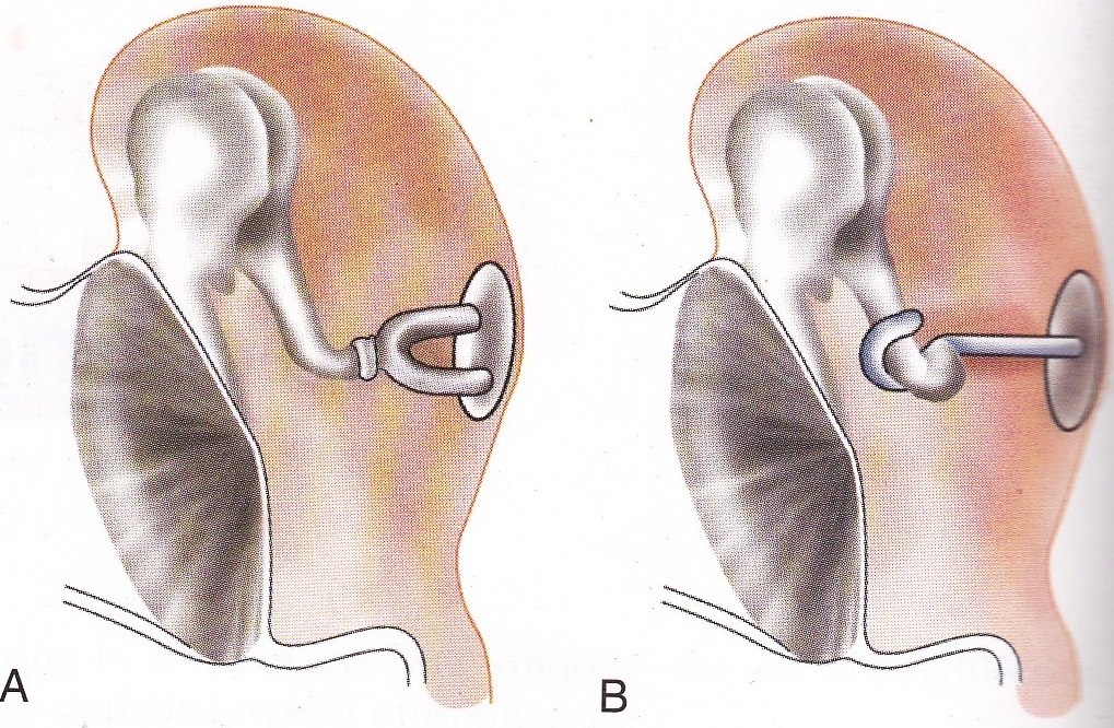 MBBS DOCTORS OTOSCLEROSIS
