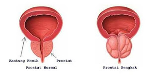 kelenjar, prostat