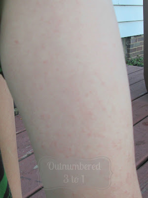 Eczema before picture www.outnumbered3-1.com