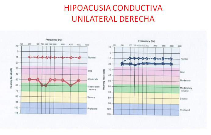 La psico-goloteca: ¿QUÉ ES UNA PÉRDIDA AUDITIVA?. LA AUDIOMETRÍA