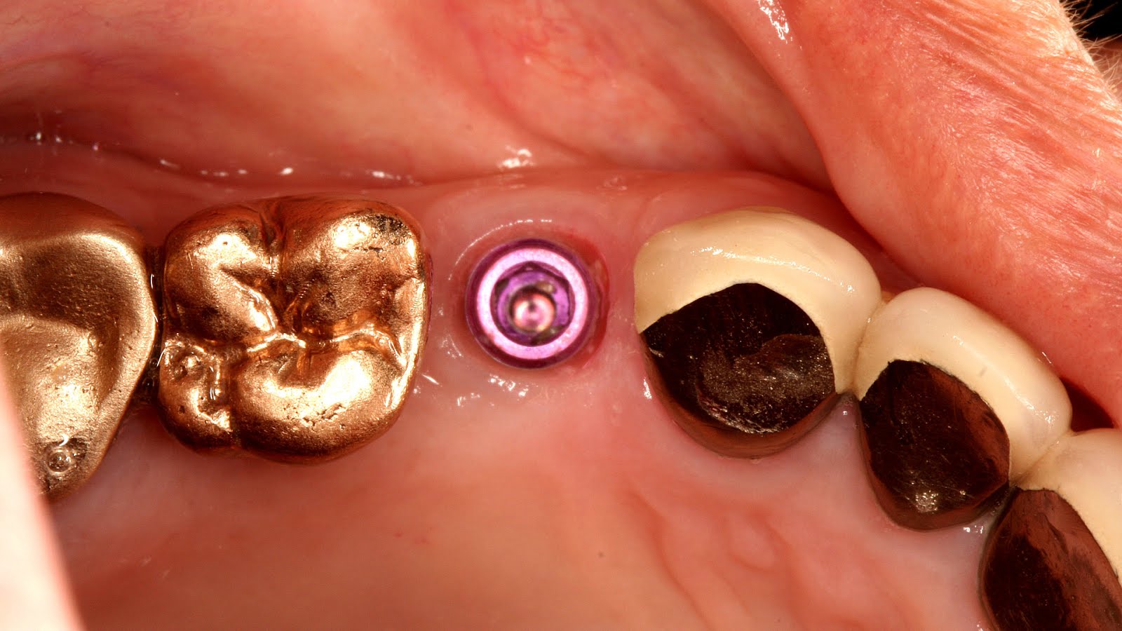 Gold Dental Implants Gold Choices