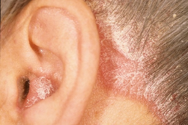 Signs And Symptoms Of Psoriasis In The Ears