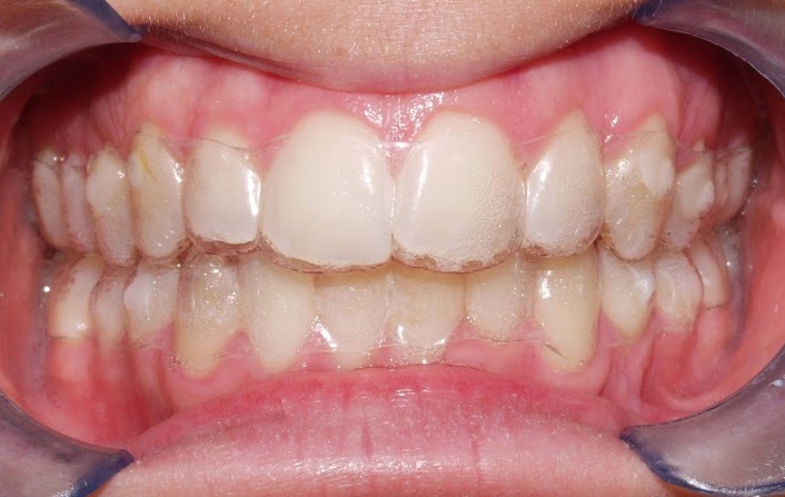 Hisaux, un geek du Milieu Test et avis Invisalign, l Hisaux, un geek du Milieu Test et avis Invisalign, l