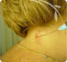 Terapia neural para hernias discales