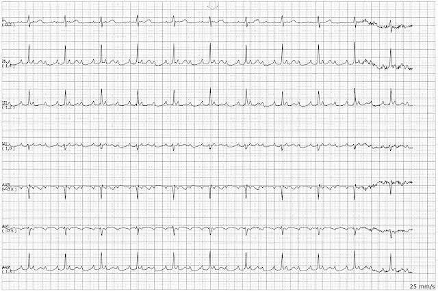 Float Nurse: Atrial Flutter with 3:1 Conduction