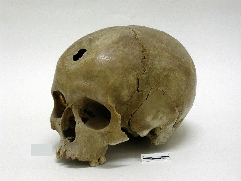 Imagen de una trepanación circular realizada en la parte frontal del cráneo