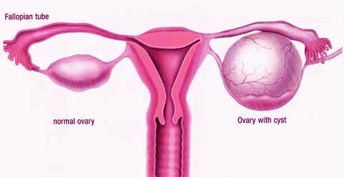 Mencegah Kanker Ovarium