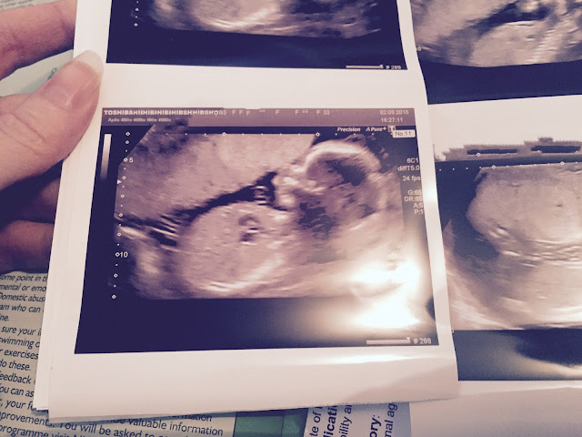 20 week pregnancy scan image