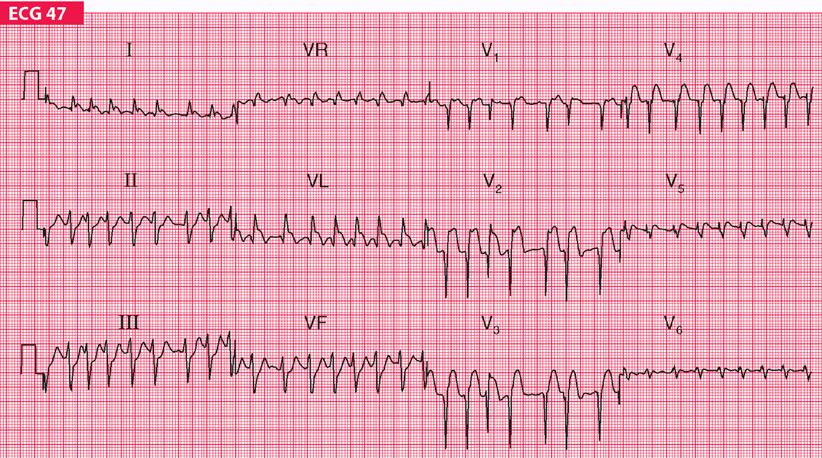 холтер наджелудочковый. ритм наджелудочковая тахикардия. желудочковая тахикардия на экг с ав блокадой. предсердная тахикардия холтер. наджелудочковая предсердная экстрасистолия экг.