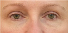 BEFOR AND AFTER EYELID SURGARY