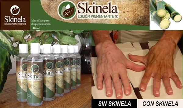 Skinela, maquillaje pigmentador para camuflar el vitiligo