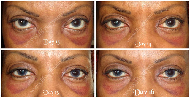 African American Ethnic Blepharoplasty (Eyelid Surgery)