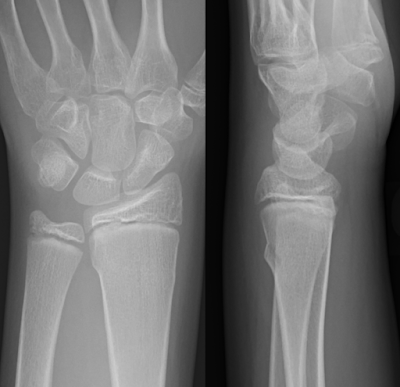Torus fracture of the distal radial metaphysis