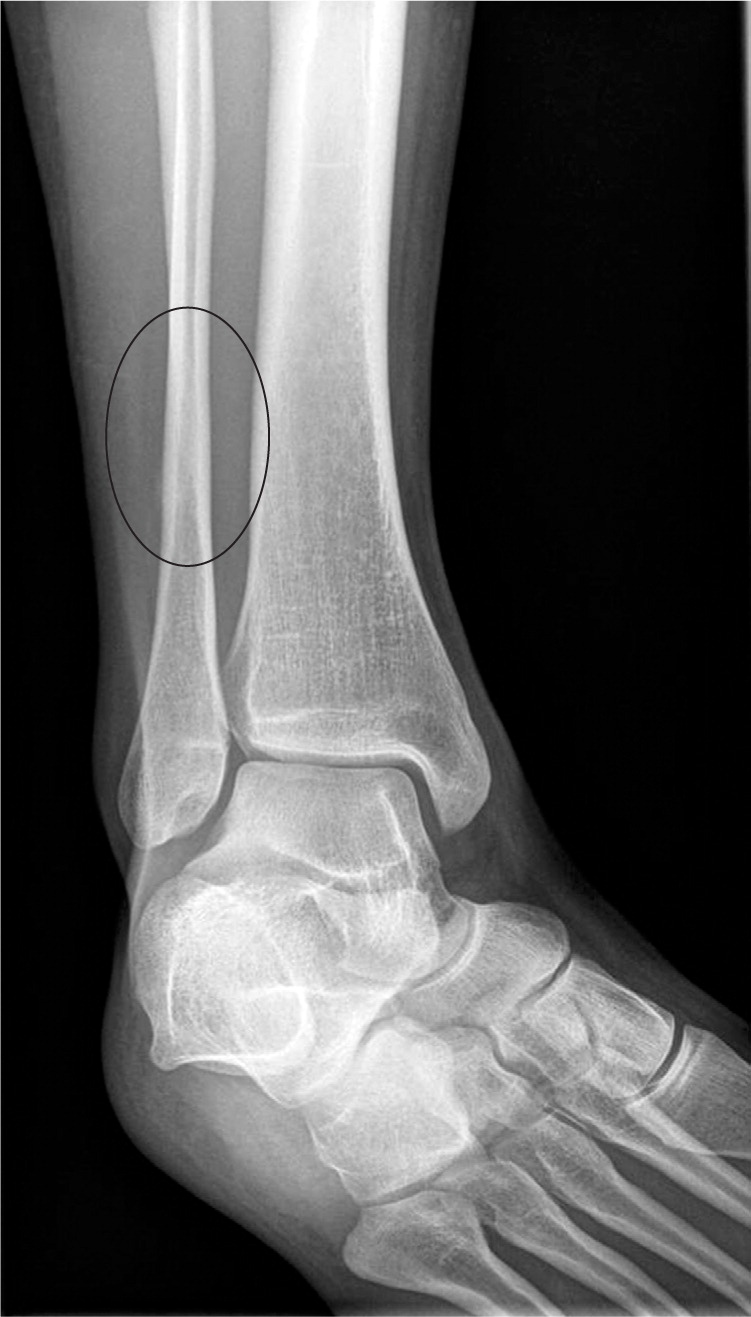 How long take stress fracture to heal?