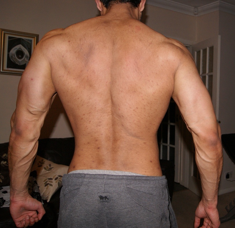 lower back rashes #11