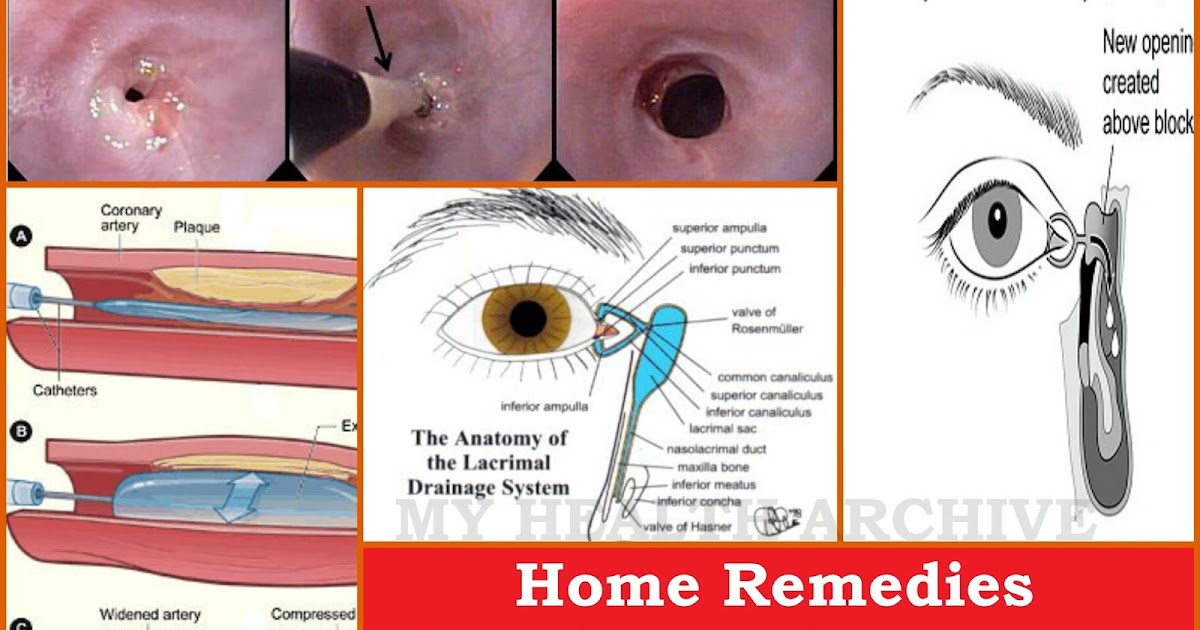 Home Remedies For Tear Duct Infection Home Remedies For Tear Duct Infection