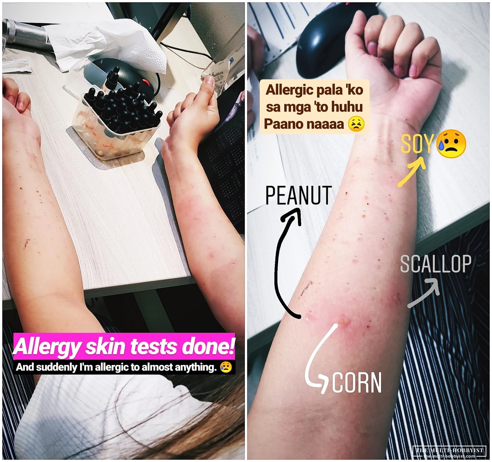 allergy skin test cost
