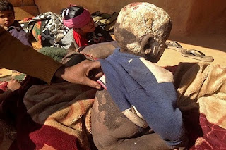 مرض فطري نادر يحول طفل إلى تمثال حجري مرض نادر، تمثال حجري، عجائب وغرائب