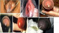 Obat Kencing Nanah Untuk Pria Obat Kencing Nanah Untuk Pria