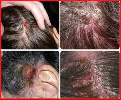 MERK OBAT GATAL DI KEPALA KULIT TIMBUL BOROK DI APOTIK MERK OBAT GATAL DI KEPALA KULIT TIMBUL BOROK DI APOTIK