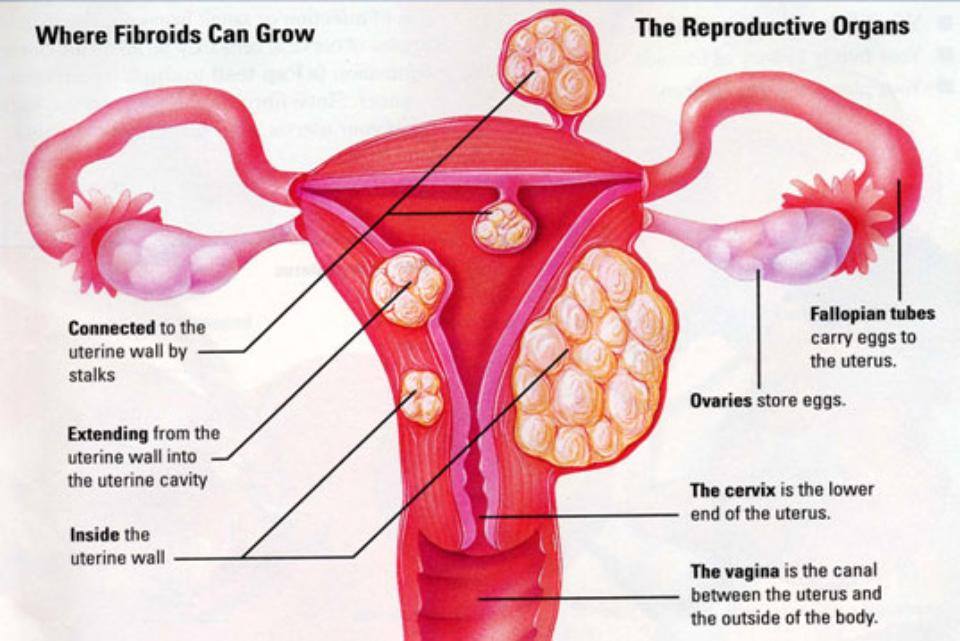 Cure Fibroid In 60 Days Without Surgery... 100% Guaranteed!: Do You