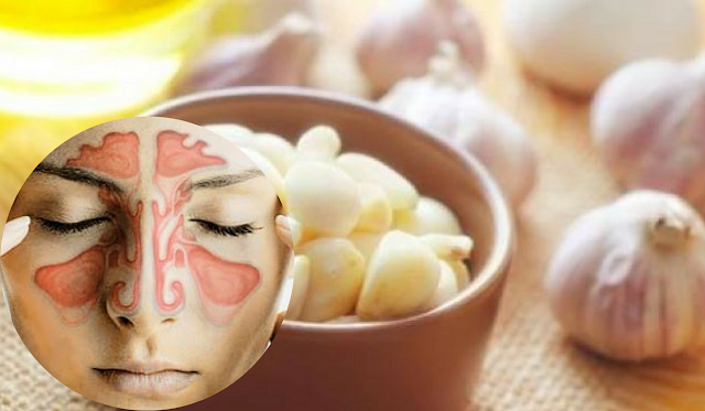 Cuma Butuh 5 Menit, Begini Cara Mengobati Penyakit Sinusitis Pakai Bawang Putih