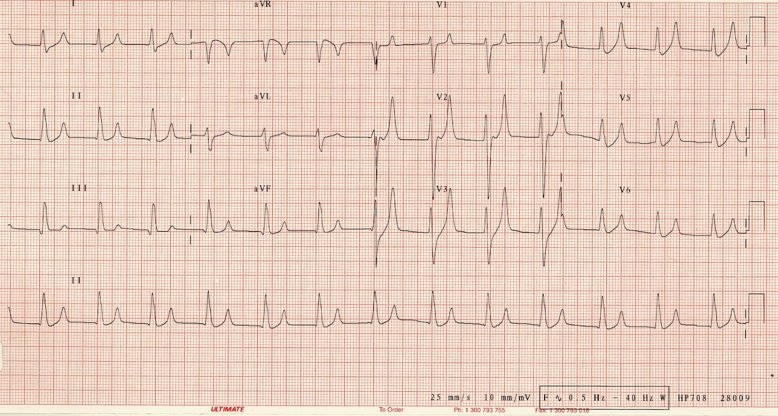 Экг при гиперкалиемии картинки