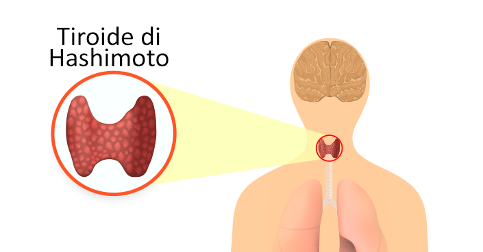 Análisis tiroides con la regla