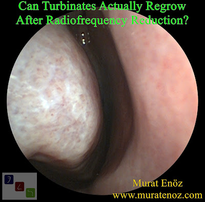 Can Turbinates Actually Regrow After Radiofrequency Reduction? - Turbinate Regrow / Hypertrophy Again After Turbinate Radifrequency