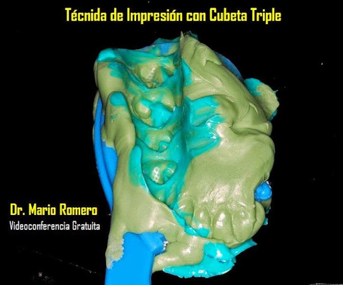 CUBETA TRIPLE: Técnica de impresión - Videoconferencia Dr. Mario Romero