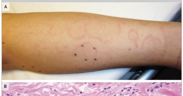AMICOR: Erythema Marginatum