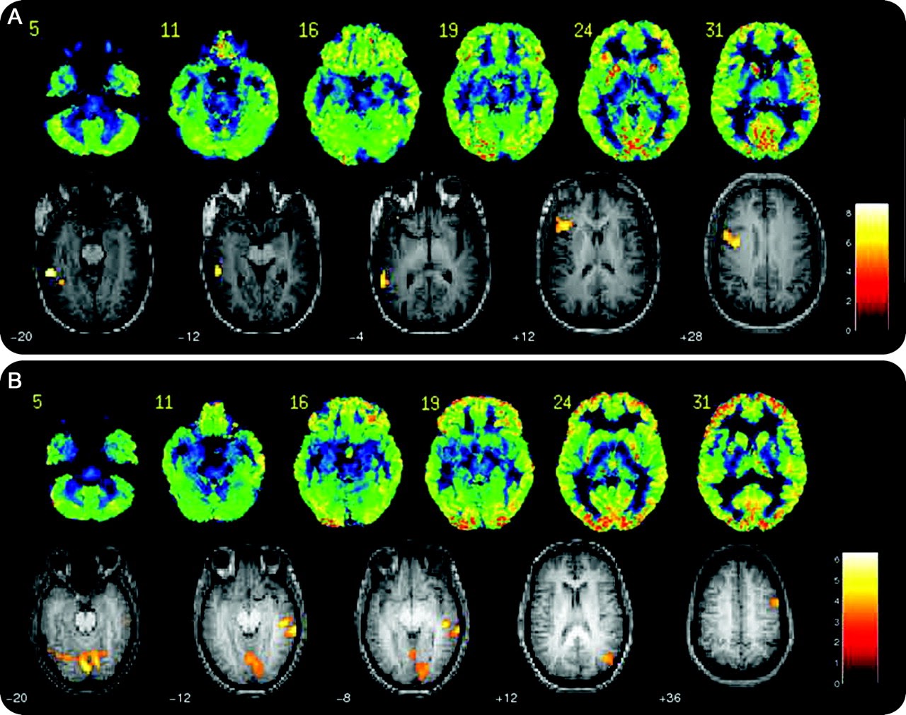 NeuromarketMe fMRI 