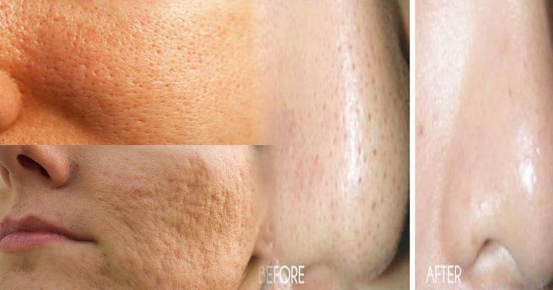 Best Natural Remedy For Blackheads Best Natural Remedy For Blackheads
