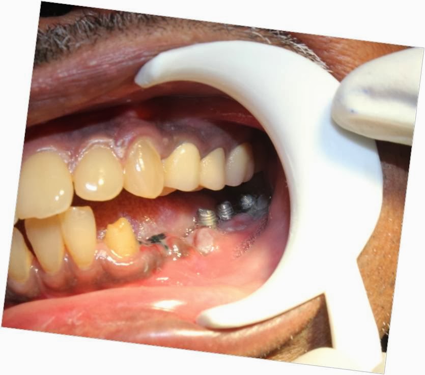 Failed tooth supported bridge removal and immediate implant placement