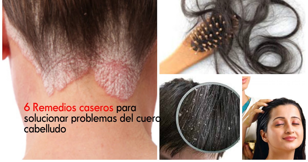 Soluciona problemas de tu cuero cabello con estos 6 remedios naturales Soluciona problemas de tu cuero cabello con estos 6 remedios naturales