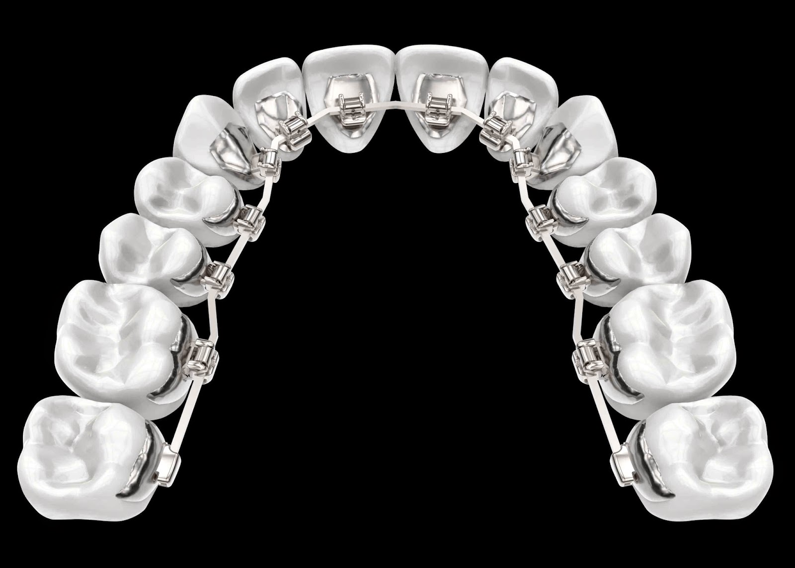 Blue Orthodontics Invisible Braces Revised