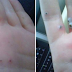 Everyone Should Be Warned! Black Spots May Appear In Your Hands Like Blood Blister And It Can Spread Anywhere!