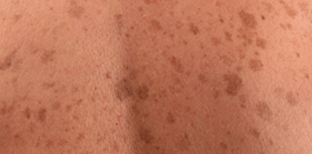 Cilt - Deri Kanseri Nedir? Cilt Kanseri Belirtileri Ve Tedavisi ...