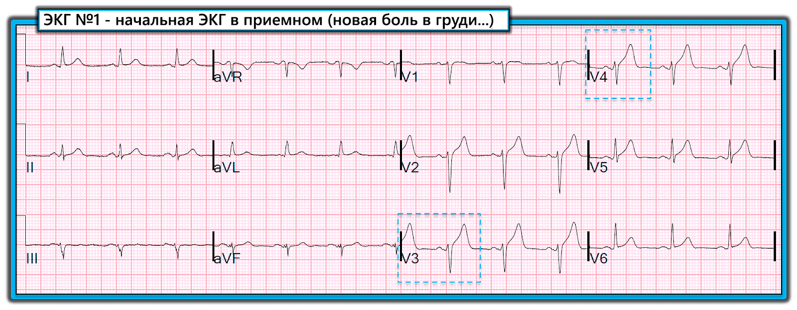 врач кардиограмма прошлого читать. врач кардиограмма прошлого читать. экг расшифровка в медицине. экг сердца с расшифровкой зубцы. экг доктор.