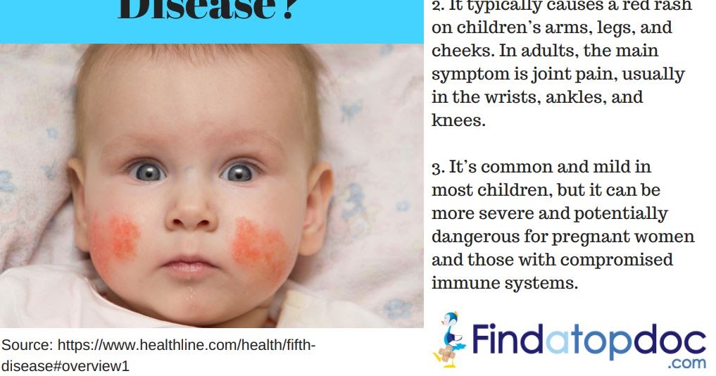 FindaTopDoc Blog What is Fifths Disease Causes and Symptoms