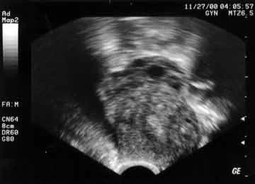 USG transvaginal dengan ovarium terjebak di atas jaringan parut USG transvaginal dengan ovarium terjebak di atas jaringan parut