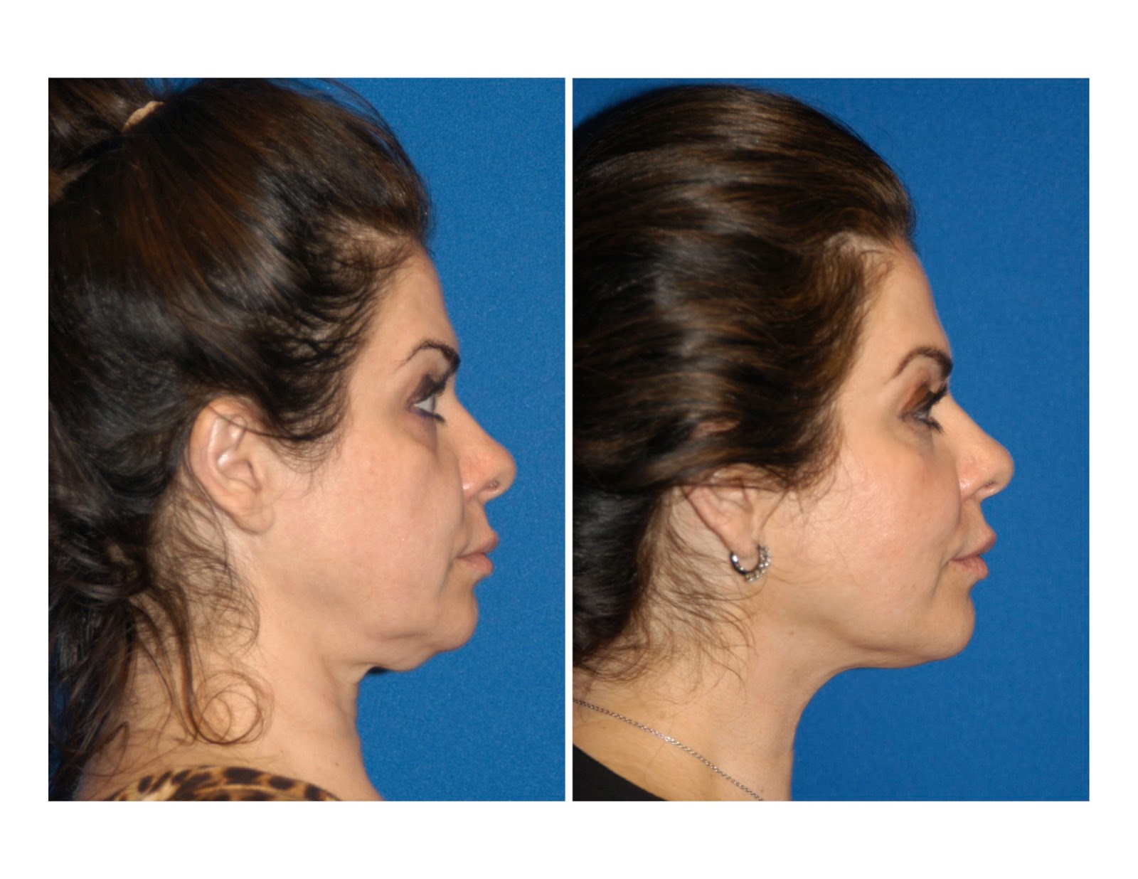 Venzen крем для шеи роликовый 110гр. второй подбородок. второй подбородок. второй подбородок. липолитик в подбородок до и после.